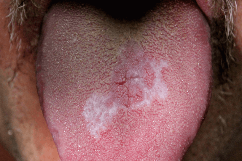A man sticks out his tongue which has a white pattern on the centre of it.