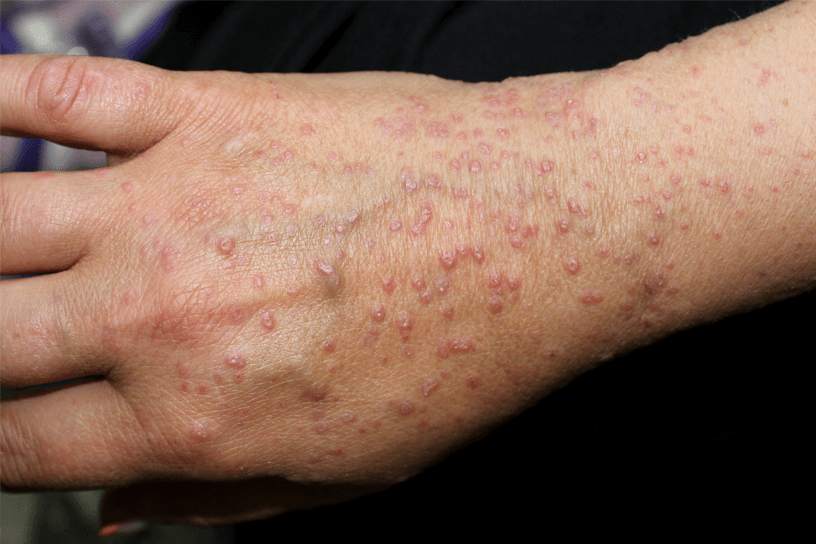 Red bumps covering the top of the hand and wrist on white skin.