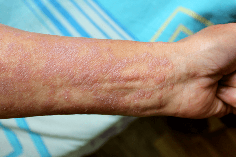 Thick scaly patches of red skin on someone with white skin. The rash affects the inside of the arm and wrist.